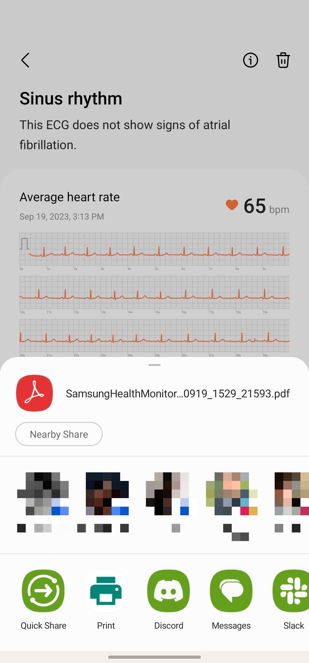 Resultados de ECG no aplicativo móvel Samsung Health Monitor, com o menu de compartilhamento aberto.