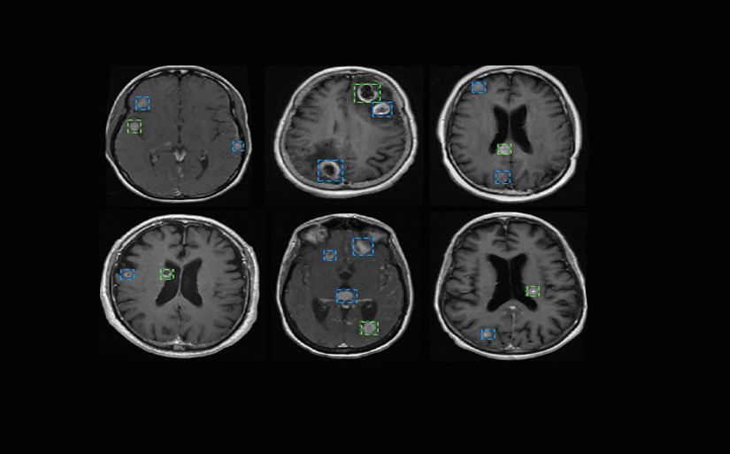 Um conjunto de seis exames de ressonância magnética cerebral exibidos em duas linhas com várias áreas destacadas por caixas azuis e verdes, indicando regiões de interesse ou anormalidades detectadas pelo software de imagem.